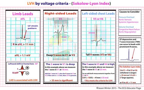 lvh voltage criteria by age